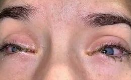 Takma kirpiklerdeki bilinmeyen tehlike! Gözünüzü kaybedebilirsiniz